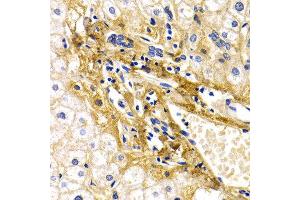 Immunohistochemistry of paraffin-embedded human liver damage using CFH antibody at dilution of 1:200 (400x lens).
