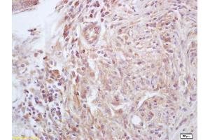 Formalin-fixed and paraffin embedded human liver carcinoma labeled with Anti-CKLF Polyclonal Antibody, Unconjugated (ABIN739650) at 1:200, followed by conjugation to the secondary antibody and DAB staining