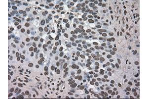 Immunohistochemical staining of paraffin-embedded Adenocarcinoma of colon tissue using anti-DHFRmouse monoclonal antibody. (Dihydrofolate Reductase antibody)