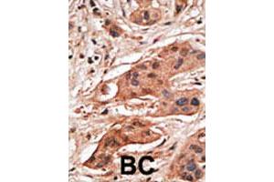 Formalin-fixed and paraffin-embedded human cancer tissue reacted with the BCL2A1 polyclonal antibody  , which was peroxidase-conjugated to the secondary antibody, followed by DAB staining. (BCL2A1 antibody  (N-Term))