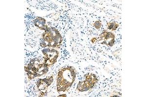 Immunohistochemistry analysis of paraffin-embedded human gastric cancer using LI Cadherin (ABIN7074493) at dilution of 1: 1500 (LI Cadherin antibody)