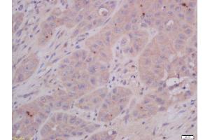 Formalin-fixed and paraffin embedded human laryngocarcinoma tissue labeled with Anti-COMMD4 Polyclonal Antibody, Unconjugated 1:400 followed by conjugation to the secondary antibody and DAB staining.