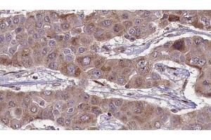 ABIN6269021 at 1/100 staining Human liver cancer tissue by IHC-P. (FSHR antibody  (Internal Region))