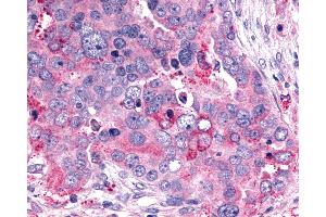 Anti-GHRHR antibody IHC of human Ovary, Carcinoma. (GHRHR antibody  (C-Term))