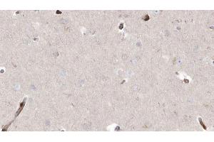 ABIN6272909 at 1/100 staining Human brain cancer tissue by IHC-P. (ABHD5 antibody  (Internal Region))