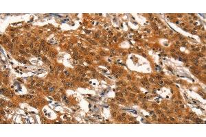Immunohistochemistry of paraffin-embedded Human gasrtic cancer tissue using DEAF1 Polyclonal Antibody at dilution 1:40