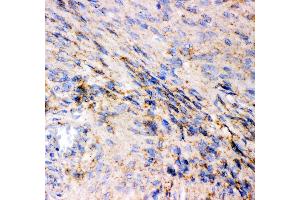 Anti- GRIA1 antibody, IHC(P) IHC(P): Human Meningeoma Tissue (Glutamate Receptor 1 antibody  (AA 19-360))