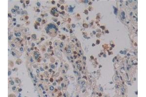 Detection of DEFa4 in Human Lung cancer Tissue using Polyclonal Antibody to Defensin Alpha 4, Corticostatin (DEFa4)
