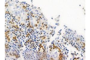 ABIN6258532 and ABIN6274803 at 1/100 staining human colon carcinoma by IHC-P.
