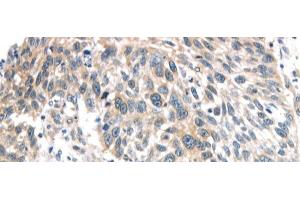 Immunohistochemistry of paraffin-embedded Human lung cancer using IQGAP2 Polyclonal Antibody at dilution of 1/40 (IQGAP2 antibody)