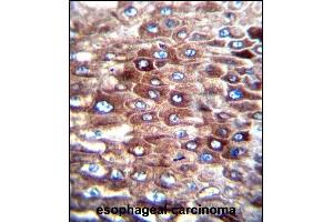 C Antibody (C-term) (ABIN656407 and ABIN2845701) immunohistochemistry analysis in formalin fixed and paraffin embedded human esophageal carcinoma followed by peroxidase conjugation of the secondary antibody and DAB staining. (CJ057 antibody  (C-Term))