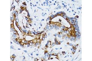 Immunohistochemistry of paraffin-embedded Human colon carcinoma using MMP7 Polyclonal Antibody at dilution of 1:100 (40x lens). (MMP7 antibody)