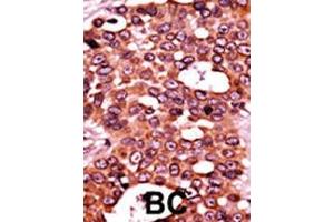 Formalin-fixed and paraffin-embedded human cancer tissue reacted with the primary antibody, which was peroxidase-conjugated to the secondary antibody, followed by AEC staining. (CDC6 antibody  (pSer54))