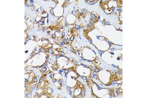 Immunohistochemistry of paraffin-embedded human breast cancer using RARα antibody (ABIN7269946) at dilution of 1:100 (40x lens). (Retinoic Acid Receptor alpha antibody)