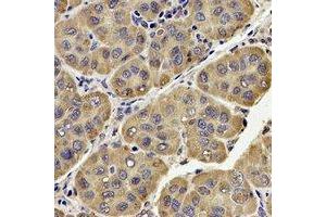 Immunohistochemical analysis of UQCRC2 staining in human liver cancer formalin fixed paraffin embedded tissue section. (UQCRC2 antibody)