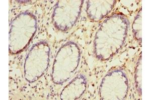 Immunohistochemistry of paraffin-embedded human colon cancer using ABIN7144679 at dilution of 1:100 (NAT2 antibody  (AA 1-290))