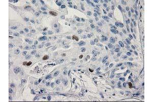 Immunohistochemical staining of paraffin-embedded Carcinoma of Human bladder tissue using anti-TP53 mouse monoclonal antibody. (p53 antibody)