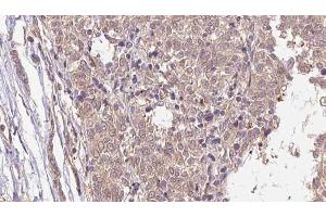 ABIN6266584 at 1/100 staining Human Melanoma tissue by IHC-P.