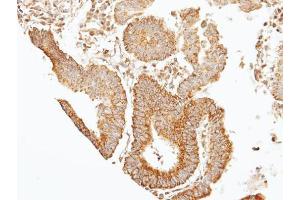 IHC-P Image Immunohistochemical analysis of paraffin-embedded human gastric cancer, using 39331, antibody at 1:100 dilution. (Septin 7 antibody)