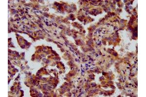IHC image of ABIN7151021 diluted at 1:600 and staining in paraffin-embedded human lung cancer performed on a Leica BondTM system. (FANCL antibody  (AA 138-248))