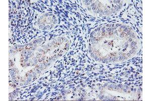Immunohistochemical staining of paraffin-embedded Adenocarcinoma of Human endometrium tissue using anti-HES1 mouse monoclonal antibody. (HES1 antibody)