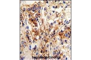 Formalin-fixed and paraffin-embedded human hepatocarcinoma reacted with CYP2J2 Antibody (N-term), which was peroxidase-conjugated to the secondary antibody, followed by DAB staining. (CYP2J2 antibody  (N-Term))