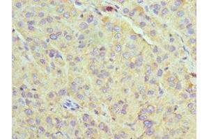 Immunohistochemistry of paraffin-embedded human liver cancer using ABIN7170632 at dilution of 1:100 (U2AF1 antibody  (AA 1-240))