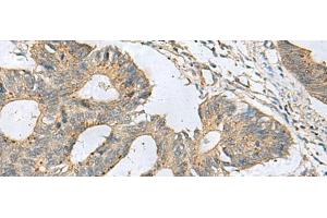 Immunohistochemistry of paraffin-embedded Human colorectal cancer tissue using CXCR5 Polyclonal Antibody at dilution of 1:80(x200) (CXCR5 antibody)