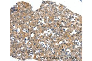 Immunohistochemistry of Human breast cancer using SCN11A Polyclonal Antibody at dilution of 1:40 (SCN11A antibody)