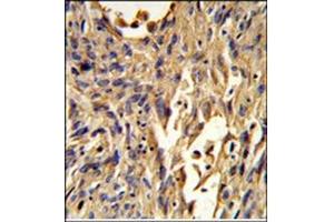 Immunohistochemistry analysis in Formalin Fixed, Paraffin Embedded Human lung carcinoma using S100A10 Antibody (Center) followed by peroxidase conjugation of the secondary antibody and DAB staining. (S100A10 antibody  (Middle Region))