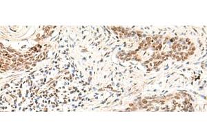 Immunohistochemistry of paraffin-embedded Human esophagus cancer tissue using HOXD9 Polyclonal Antibody at dilution of 1:30(x200) (HOXD9 antibody)