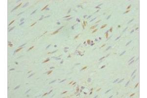 Immunohistochemistry of paraffin-embedded human colon cancer using ABIN7168762 at dilution of 1:100 (SEPHS1 antibody  (AA 1-392))