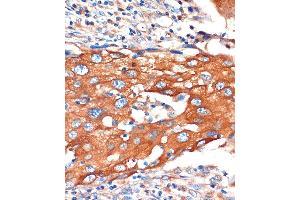 Immunohistochemistry of paraffin-embedded Human breast cancer using IQG Rabbit pAb (ABIN7268022) at dilution of 1:100 (40x lens). (IQGAP2 antibody  (AA 1330-1440))