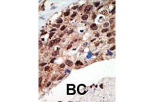 Formalin-fixed and paraffin-embedded human cancer tissue reacted with the SETD7 polyclonal antibody  , which was peroxidase-conjugated to the secondary antibody, followed by DAB staining.