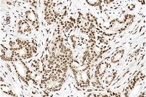 Immunohistochemical analysis of paraffin-embedded human breast cancer tissue using (ABIN1881702 and ABIN2838736).