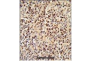 Formalin-fixed and paraffin-embedded human lymphoma reacted with LCK Antibody (C-term), which was peroxidase-conjugated to the secondary antibody, followed by DAB staining. (LCK antibody  (C-Term))