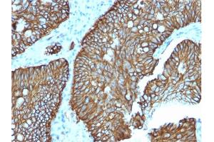 Formalin-fixed, paraffin-embedded human Colon stained with Cadherin 17 / CDH17 Mouse Monoclonal Antibody (CDH17/2618). (LI Cadherin antibody  (AA 242-418))