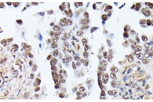 Immunohistochemistry of paraffin-embedded Human lung cancer using TPI1 Polyclonal Antibody at dilution of 1:100 (40x lens). (TPI1 antibody)