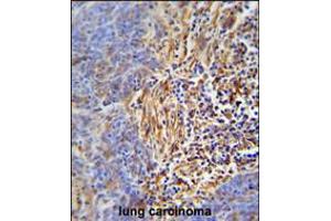 HLA-DRB5 Antibody immunohistochemistry analysis in formalin fixed and paraffin embedded human lung carcinoma followed by peroxidase conjugation of the secondary antibody and DAB staining. (HLA-DRB5 antibody  (AA 43-70))
