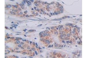 Detection of SHMT2 in Human Breast cancer Tissue using Polyclonal Antibody to Serine Hydroxymethyltransferase 2, Mitochondrial (SHMT2) (SHMT2 antibody  (AA 30-504))