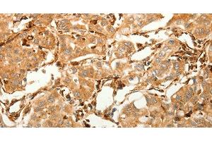 Immunohistochemistry of paraffin-embedded Human lung cancer tissue using SFRP1 Polyclonal Antibody at dilution 1:80 (SFRP1 antibody)