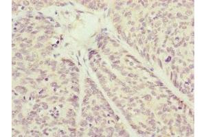 Immunohistochemistry of paraffin-embedded human ovarian cancer using ABIN7149183 at dilution of 1:100 (COX7A2L antibody  (AA 1-114))