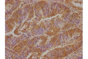IHC image of ABIN7175200 diluted at 1:100 and staining in paraffin-embedded human colon cancer performed on a Leica BondTM system. (VSTM2L antibody  (AA 25-204))