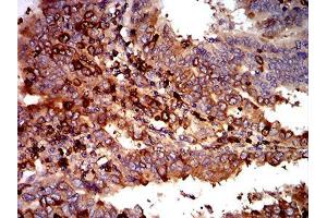 Immunohistochemical analysis of paraffin-embedded endometrial cancer tissues using C3C mouse mAb with DAB staining. (Complement C3c antibody  (AA 1521-1649))
