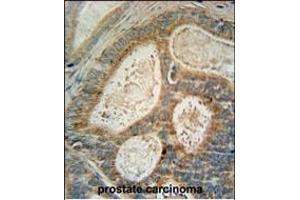 INSIG1 Antibody (N-term) (ABIN652887 and ABIN2842574) immunohistochemistry analysis in formalin fixed and paraffin embedded human prostate carcinoma followed by peroxidase conjugation of the secondary antibody and DAB staining.