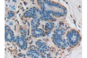 DAB staining on IHC-P; Samples: Human Breast cancer Tissue (CNTNAP1 antibody  (AA 926-1190))