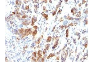 Formalin-fixed, paraffin-embedded human gastric carcinoma stained with MUC5 antibody (MUC5AC/917). (MUC5AC antibody)