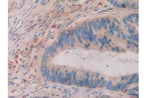 Detection of ATF4 in Human Colorectal cancer Tissue using Polyclonal Antibody to Activating Transcription Factor 4 (ATF4) (ATF4 antibody  (AA 130-347))