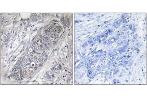 Immunohistochemistry analysis of paraffin-embedded human breast carcinoma tissue, using 4E-BP1 (Ab-45) Antibody. (eIF4EBP1 antibody  (AA 13-62))