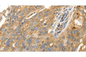Immunohistochemistry of paraffin-embedded Human ovarian cancer using CALR Polyclonal Antibody at dilution of 1:50 (Calreticulin antibody)